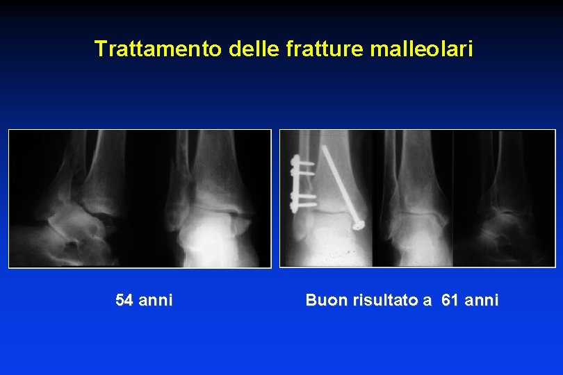 Trattamento delle fratture malleolari 54 anni Buon risultato a 61 anni 