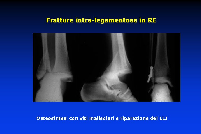 Fratture intra-legamentose in RE Osteosintesi con viti malleolari e riparazione del LLI 