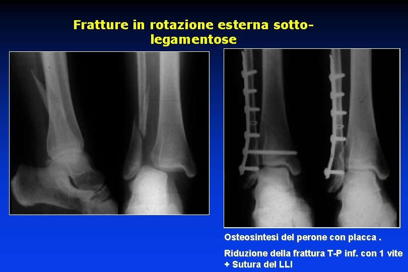 Fratture in rotazione esterna sottolegamentose Osteosintesi del perone con placca. Riduzione della frattura T-P