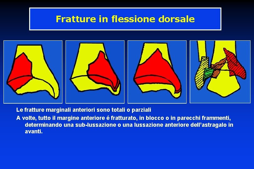 Fratture in flessione dorsale Le fratture marginali anteriori sono totali o parziali A volte,