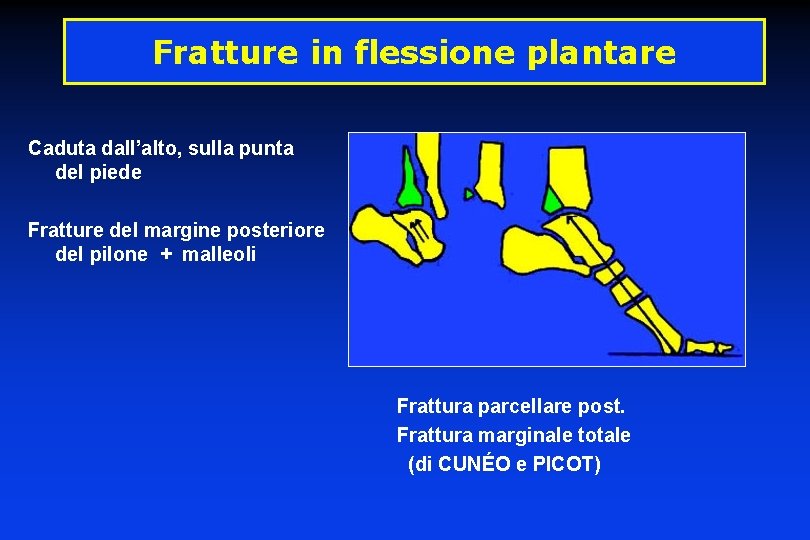 Fratture in flessione plantare Caduta dall’alto, sulla punta del piede Fratture del margine posteriore