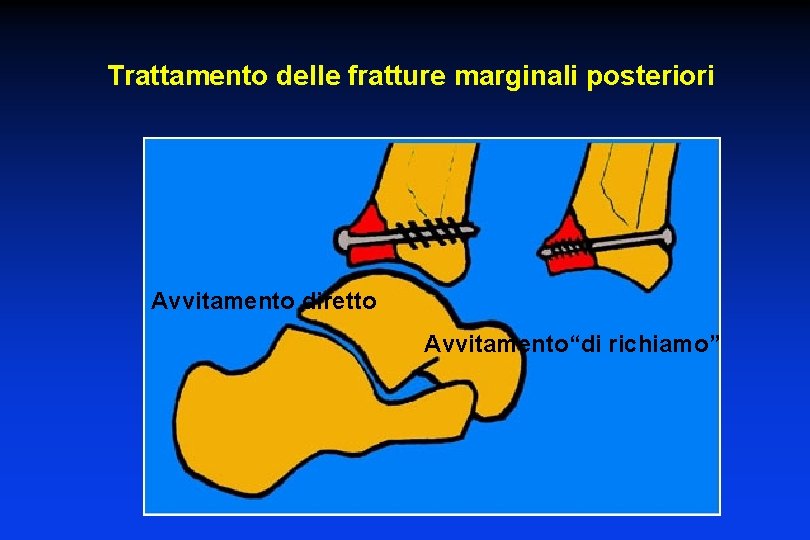 Trattamento delle fratture marginali posteriori Avvitamento diretto Avvitamento“di richiamo” 