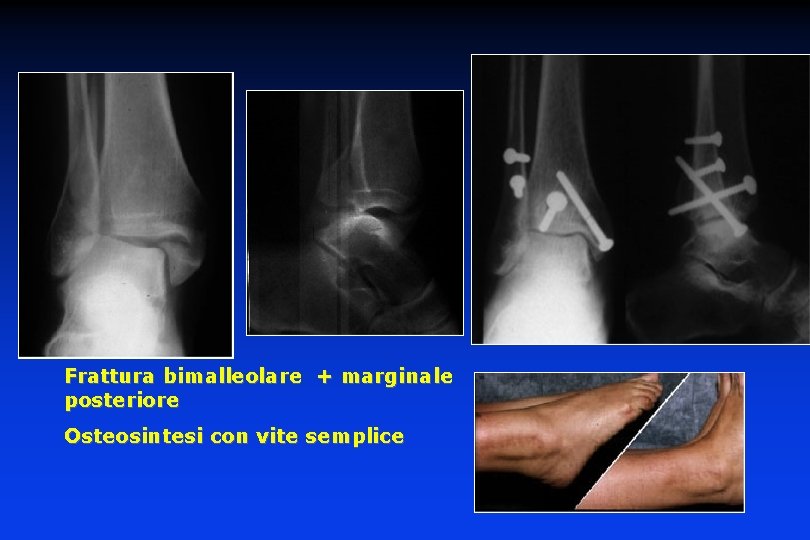 Frattura bimalleolare + marginale posteriore Osteosintesi con vite semplice 