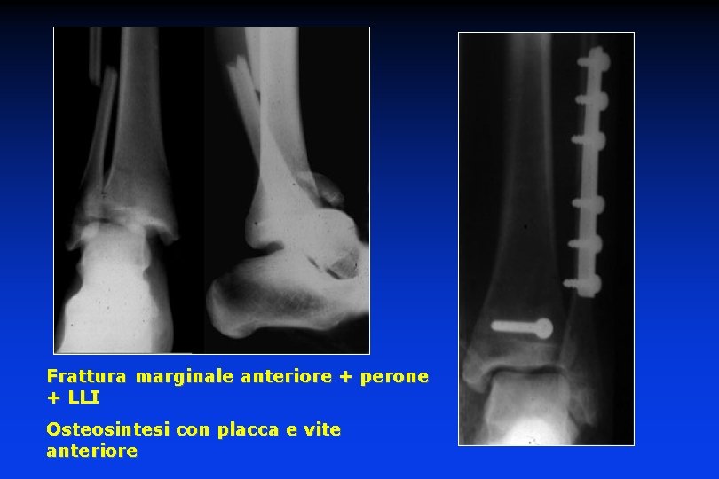 Frattura marginale anteriore + perone + LLI Osteosintesi con placca e vite anteriore 