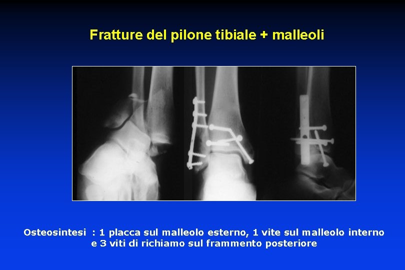 Fratture del pilone tibiale + malleoli Osteosintesi : 1 placca sul malleolo esterno, 1