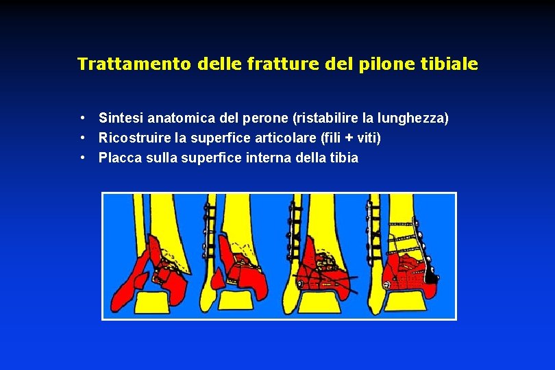 Trattamento delle fratture del pilone tibiale • Sintesi anatomica del perone (ristabilire la lunghezza)