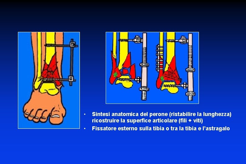  • • Sintesi anatomica del perone (ristabilire la lunghezza) ricostruire la superfice articolare