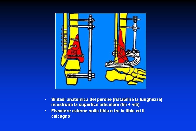  • • Sintesi anatomica del perone (ristabilire la lunghezza) ricostruire la superfice articolare