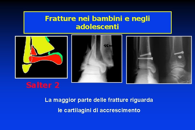 Fratture nei bambini e negli adolescenti 15 ans Salter 2 La maggior parte delle