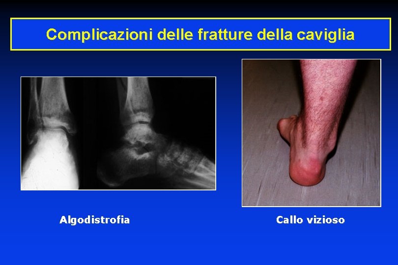 Complicazioni delle fratture della caviglia Algodistrofia Callo vizioso 