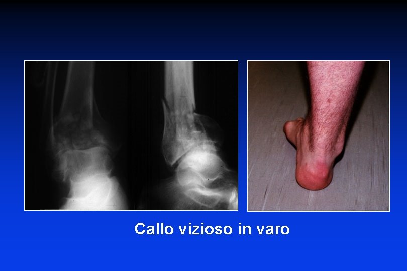 Callo vizioso in varo 