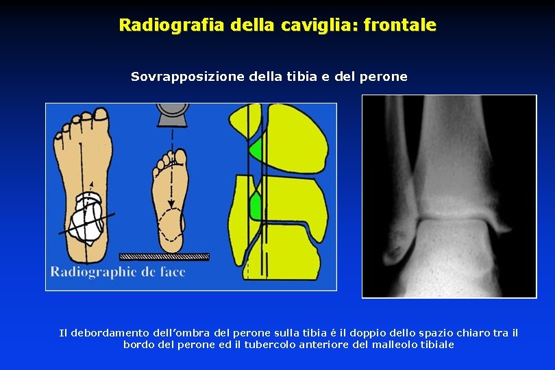 Radiografia della caviglia: frontale Sovrapposizione della tibia e del perone Il debordamento dell’ombra del