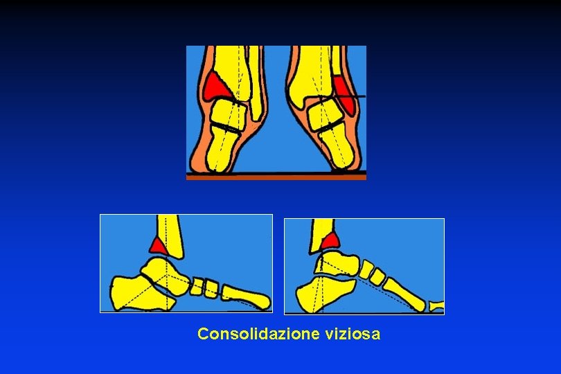 Consolidazione viziosa 