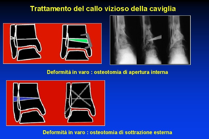 Trattamento del callo vizioso della caviglia Deformità in varo : osteotomia di apertura interna