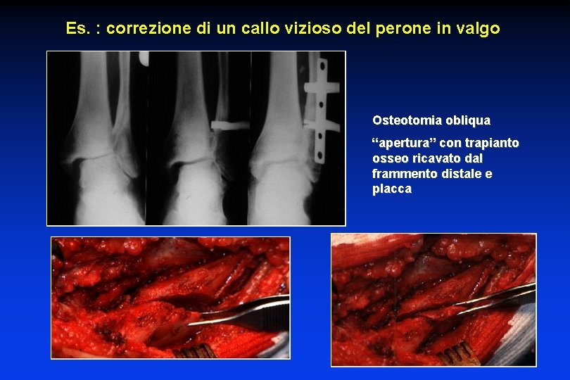 Es. : correzione di un callo vizioso del perone in valgo Osteotomia obliqua “apertura”
