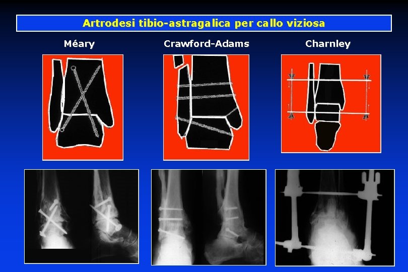 Artrodesi tibio-astragalica per callo viziosa Méary Crawford-Adams Charnley 