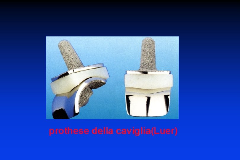 prothese della caviglia(Luer) caviglia 