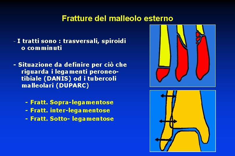 Fratture del malleolo esterno - I tratti sono : trasversali, spiroidi o comminuti -