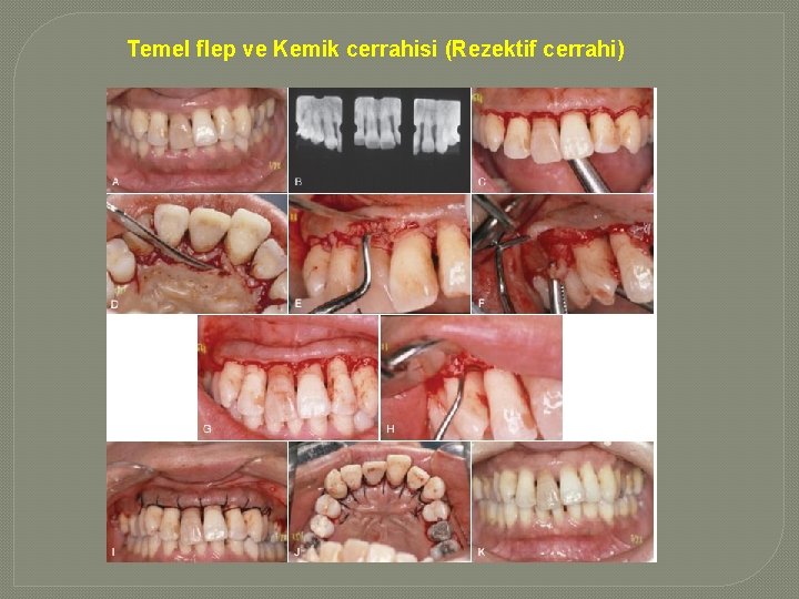 Temel flep ve Kemik cerrahisi (Rezektif cerrahi) Temel flep ve Kemik cerrahisi (Rezektif cerrahi)