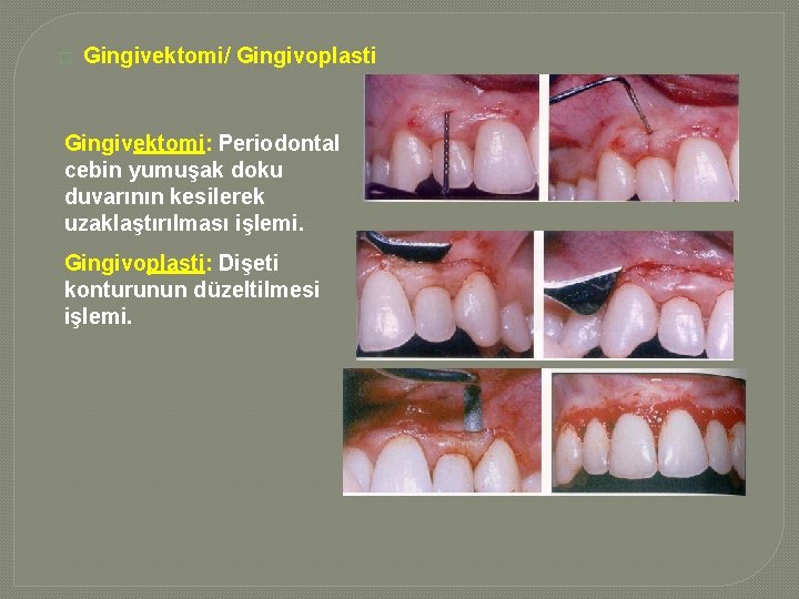 � Gingivektomi/ Gingivoplasti Gingivektomi: Periodontal cebin yumuşak doku duvarının kesilerek uzaklaştırılması işlemi. Gingivoplasti: Dişeti � Gingivektomi/ Gingivoplasti Gingivektomi: Periodontal cebin yumuşak doku duvarının kesilerek uzaklaştırılması işlemi. Gingivoplasti: Dişeti