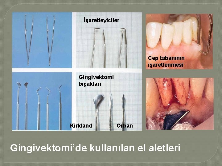 İşaretleyiciler Cep tabanının işaretlenmesi Gingivektomi bıçakları Kirkland Orban Gingivektomi’de kullanılan el aletleri İşaretleyiciler Cep tabanının işaretlenmesi Gingivektomi bıçakları Kirkland Orban Gingivektomi’de kullanılan el aletleri
