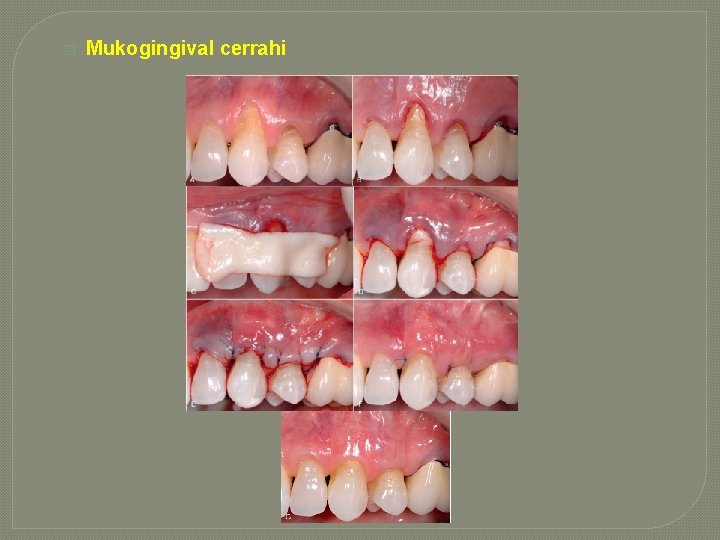 � Mukogingival cerrahi � Mukogingival cerrahi