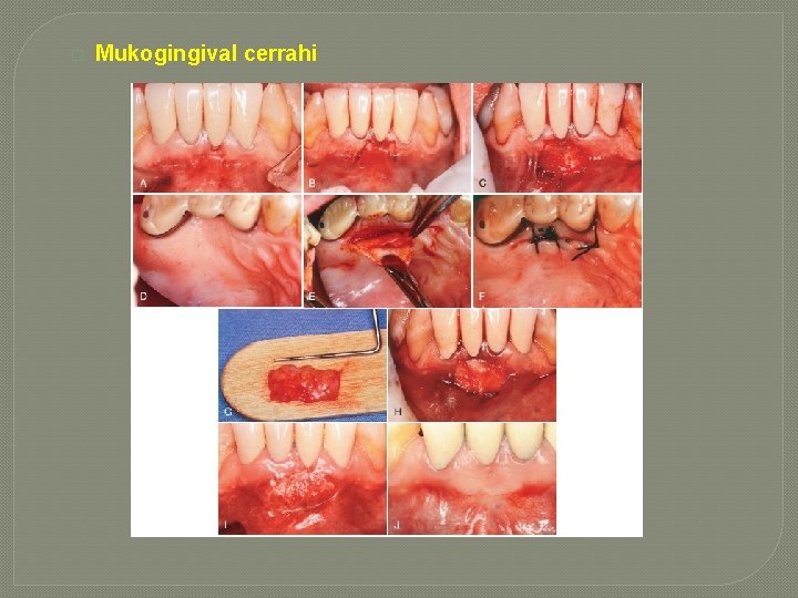 � Mukogingival cerrahi � Mukogingival cerrahi