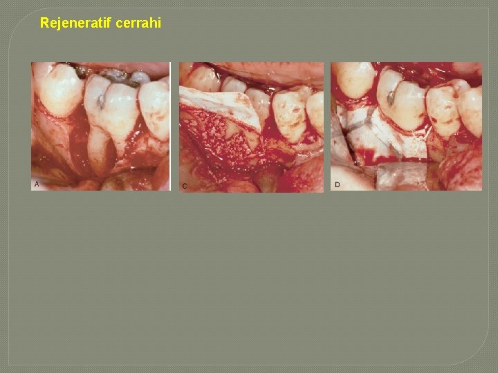 Rejeneratif cerrahi Rejeneratif cerrahi