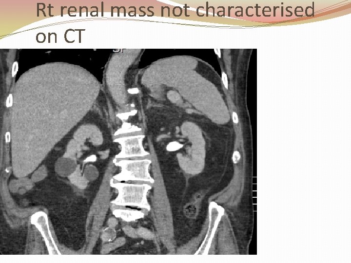 Rt renal mass not characterised on CT 