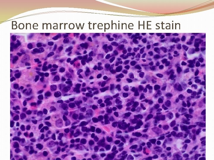 Bone marrow trephine HE stain 