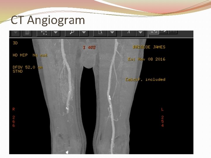 CT Angiogram 