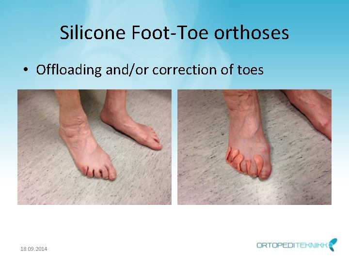Silicone Foot-Toe orthoses • Offloading and/or correction of toes 18. 09. 2014 