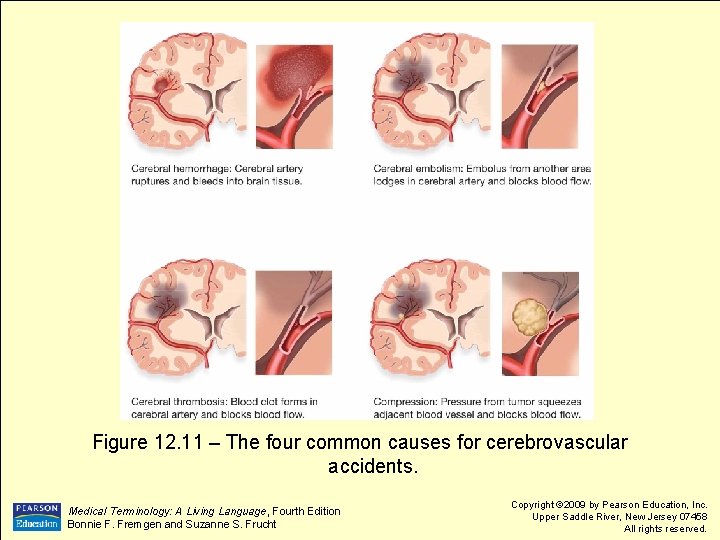 Figure 12. 11 – The four common causes for cerebrovascular accidents. Medical Terminology: A