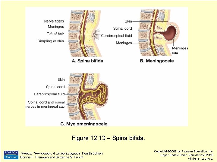 Figure 12. 13 – Spina bifida. Medical Terminology: A Living Language, Fourth Edition Bonnie