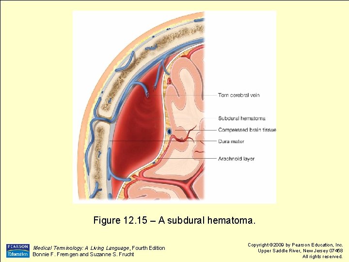 Figure 12. 15 – A subdural hematoma. Medical Terminology: A Living Language, Fourth Edition