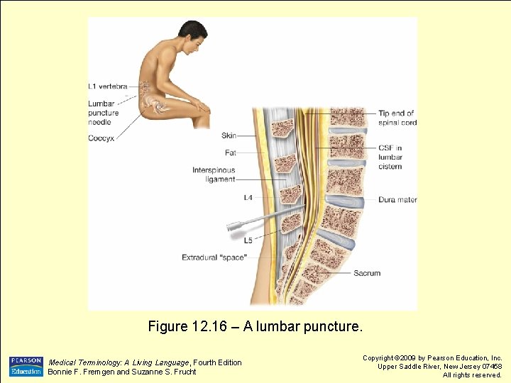 Figure 12. 16 – A lumbar puncture. Medical Terminology: A Living Language, Fourth Edition