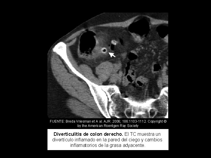 FUENTE: Breda Vriesman et A al. AJR. 2006; 186: 1103 -1112. Copyright © by