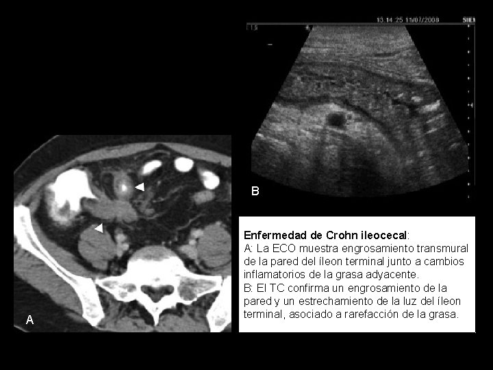 B A Enfermedad de Crohn ileocecal: A: La ECO muestra engrosamiento transmural de la
