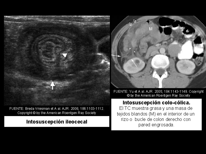 FUENTE: Yu et A al. AJR. 2005; 184: 1143 -1149. Copyright © by the