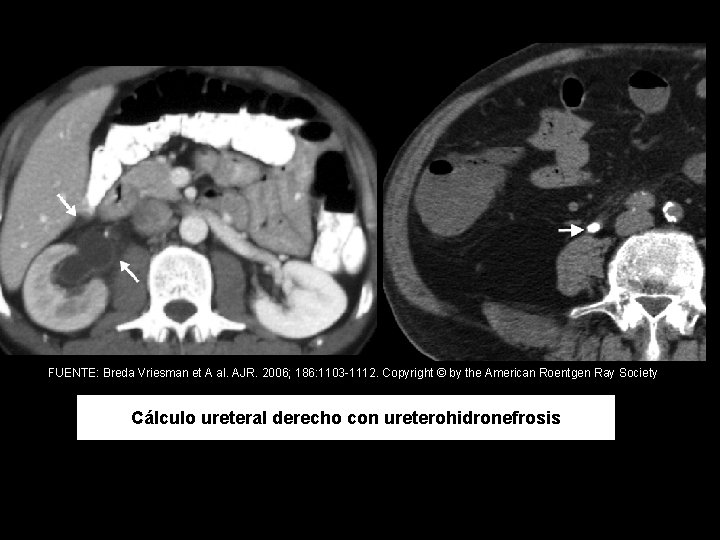 FUENTE: Breda Vriesman et A al. AJR. 2006; 186: 1103 -1112. Copyright © by