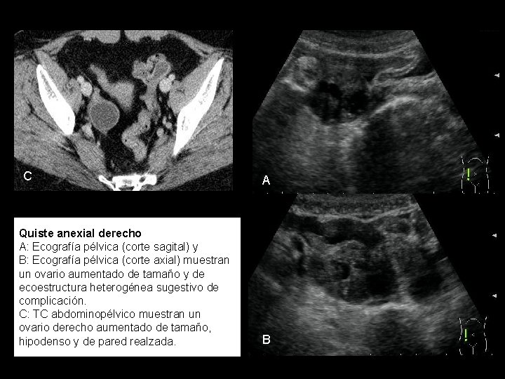 C Quiste anexial derecho A: Ecografía pélvica (corte sagital) y B: Ecografía pélvica (corte