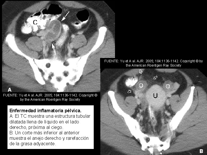 FUENTE: Yu et A al. AJR. 2005; 184: 1136 -1142. Copyright © by the