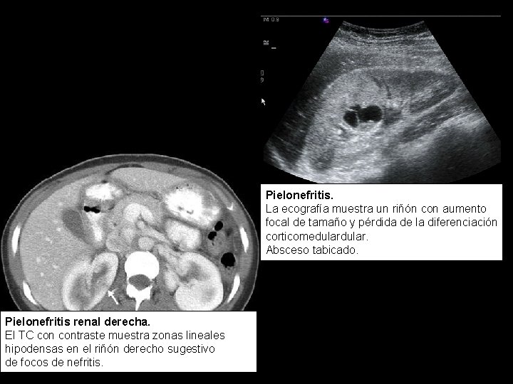 Pielonefritis. La ecografía muestra un riñón con aumento focal de tamaño y pérdida de