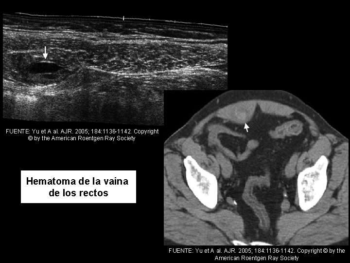 FUENTE: Yu et A al. AJR. 2005; 184: 1136 -1142. Copyright © by the