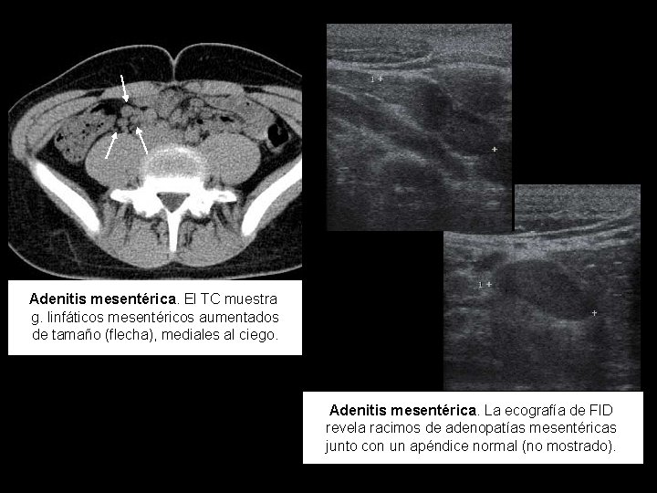 Adenitis mesentérica. El TC muestra g. linfáticos mesentéricos aumentados de tamaño (flecha), mediales al