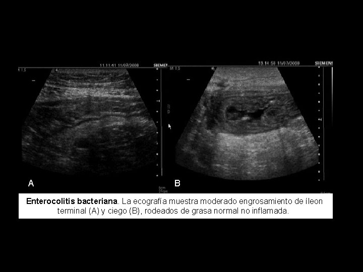 A B Enterocolitis bacteriana. La ecografía muestra moderado engrosamiento de íleon terminal (A) y