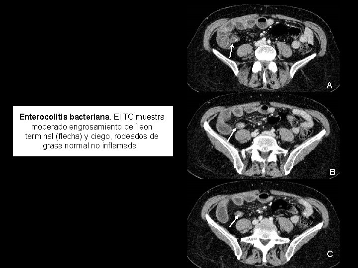 A Enterocolitis bacteriana. El TC muestra moderado engrosamiento de íleon terminal (flecha) y ciego,