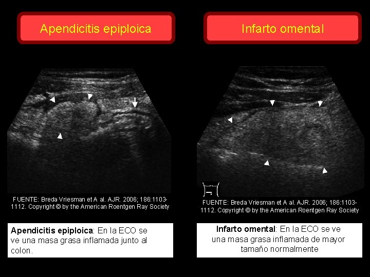 Apendicitis epiploica FUENTE: Breda Vriesman et A al. AJR. 2006; 186: 11031112. Copyright ©