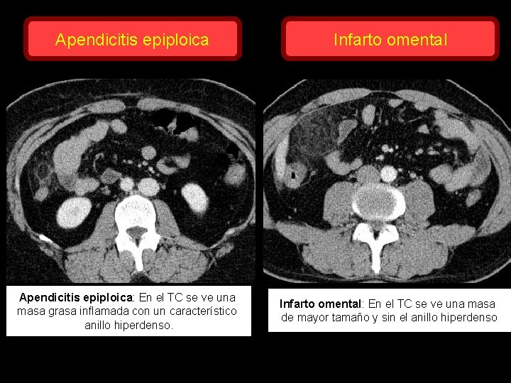 Apendicitis epiploica: En el TC se ve una masa grasa inflamada con un característico