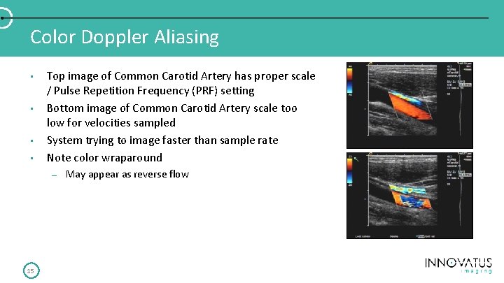 Color Doppler Aliasing • • Top image of Common Carotid Artery has proper scale Color Doppler Aliasing • • Top image of Common Carotid Artery has proper scale